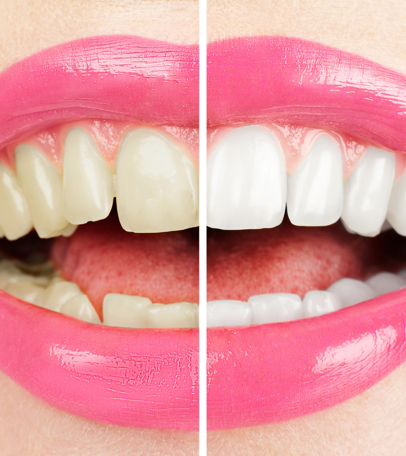 Teeth Before After Whitening