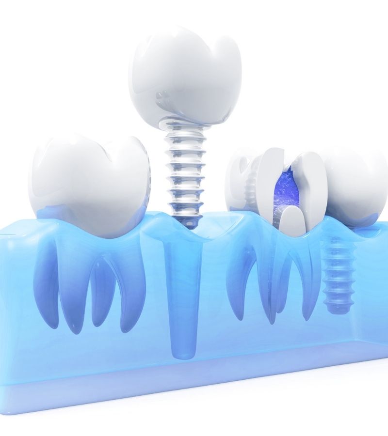 Single Tooth Implants